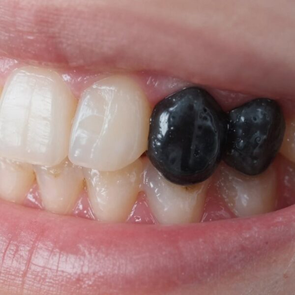 Czarny ząb przy dziąśle
