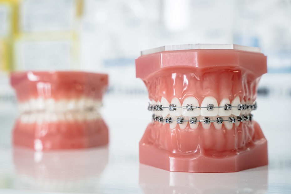 Ortodoncja u dorosłych — czy warto rozpocząć leczenie po 30. lub 40. roku życia?