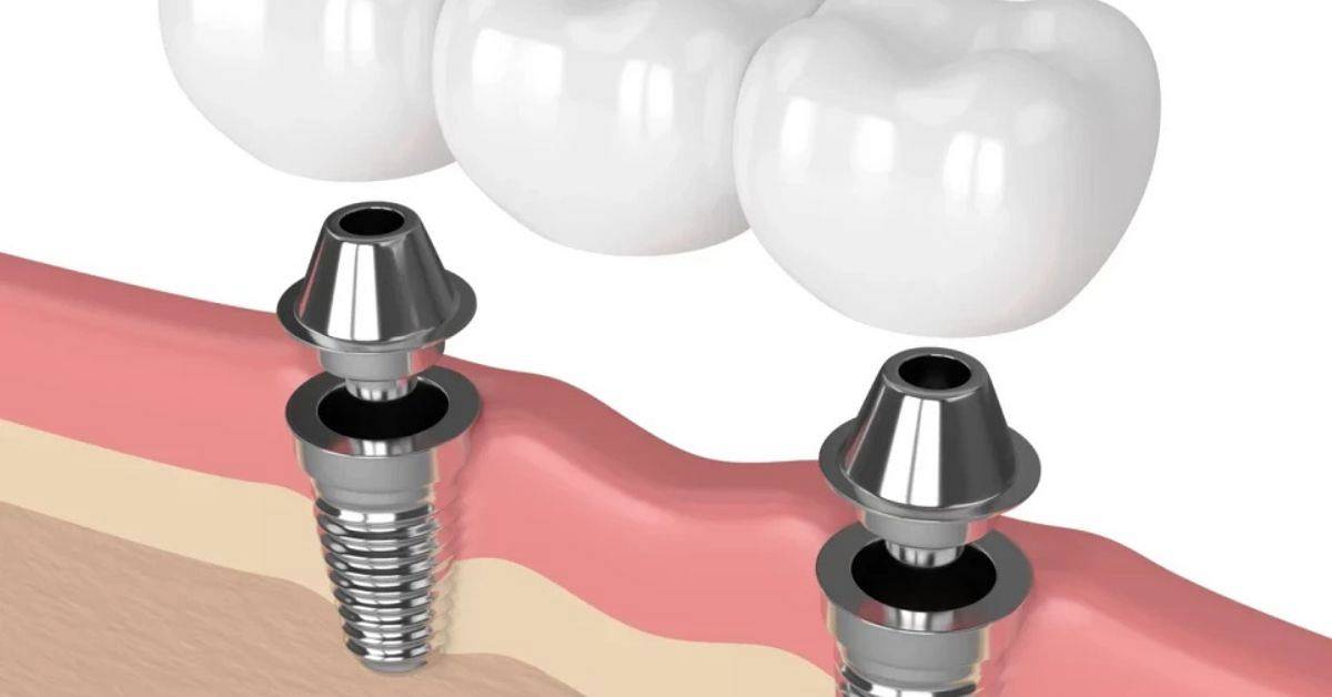 saw-dental.jpg