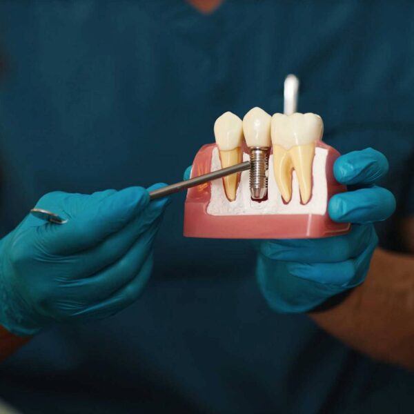 Implant zębowy krok po kroku – co dzieje się od konsultacji do odbudowy zęba?