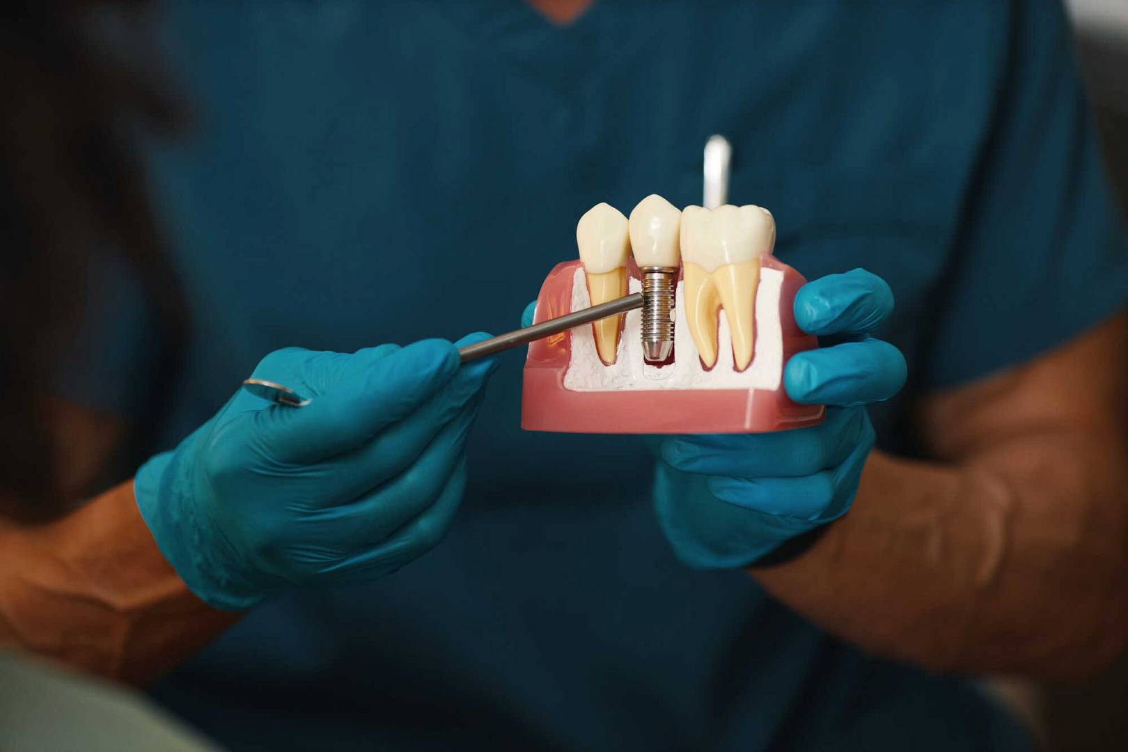 Implant zębowy krok po kroku – co dzieje się od konsultacji do odbudowy zęba?